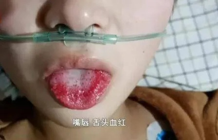 医院紧急回应，3岁女孩铊中毒事件，竟是人为投毒！